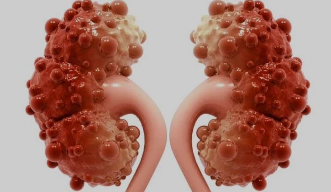 Two kidneys with cysts, viewed from the front, showing enlarged, bumpy surfaces and connecting ureters, with a plain background.